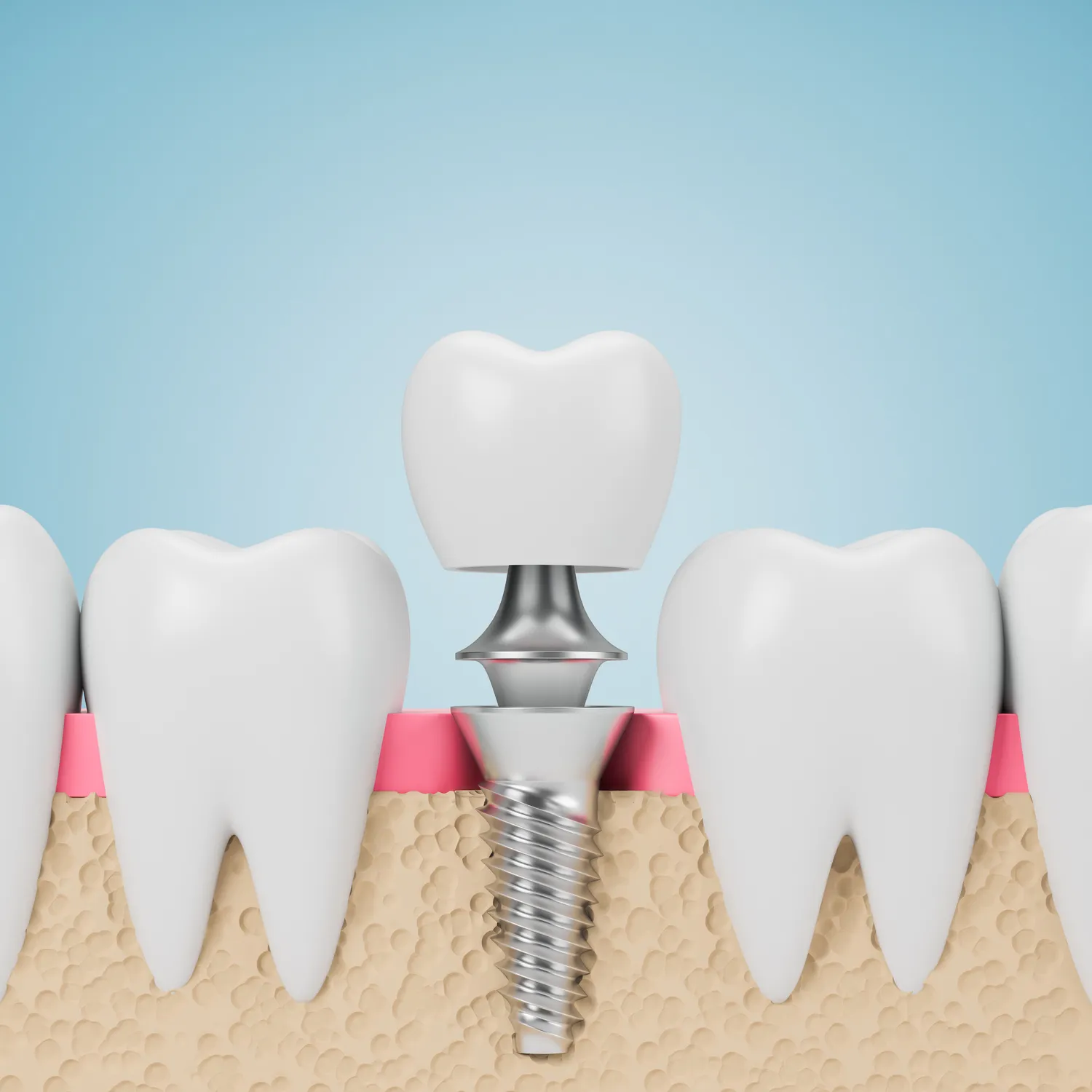 Kiedy po wyrwaniu zęba można wstawić implant?